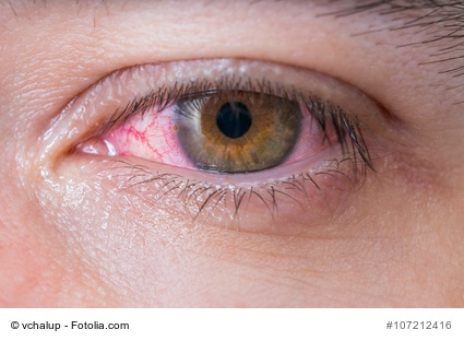 Trockene Oder Allergische Augen Ihre Apotheke Gibt Rat