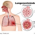 Lungenentzündung | Ihre Apotheke informiert
