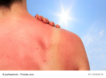 Sonnenbrand | Ihre Apotheke informiert über den richtigen Schutz