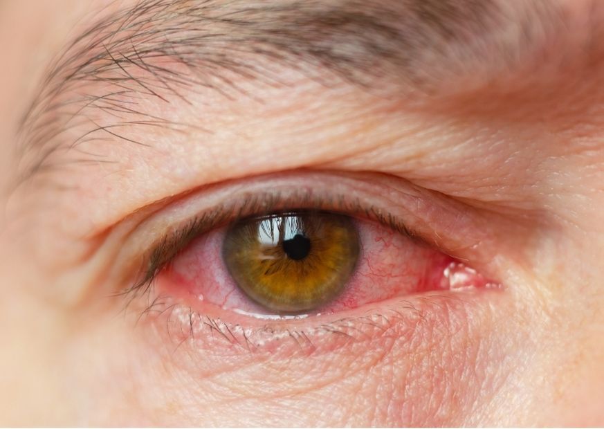 Augengesundheit: Bindehautentzündung (Konjunktivitis)