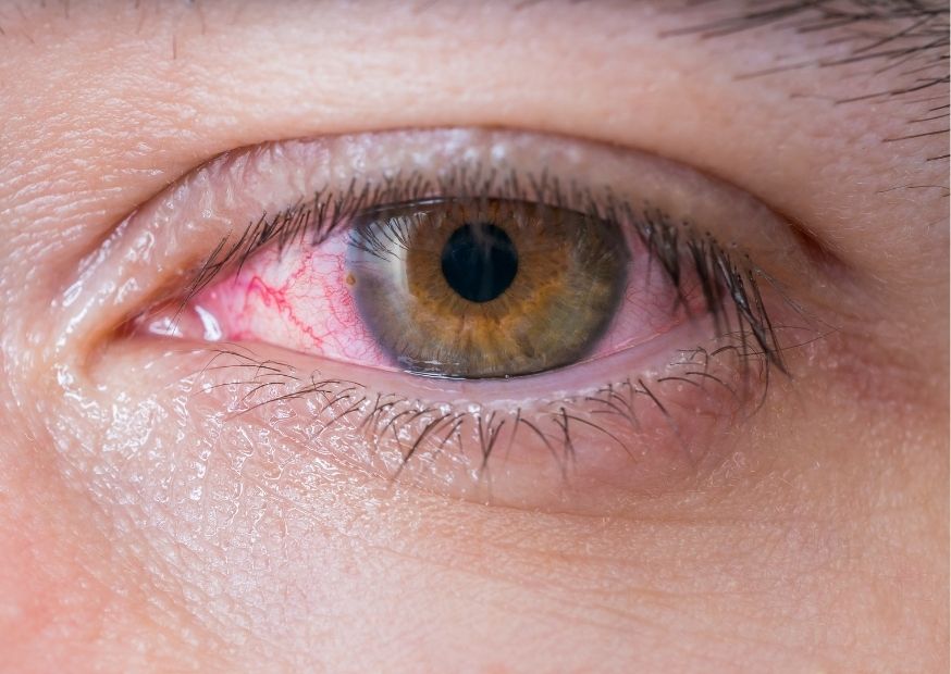 Grüner Star (Glaukom): Typische Augenerkrankung im Alter › Info-Seite -  medikamente-per-klick