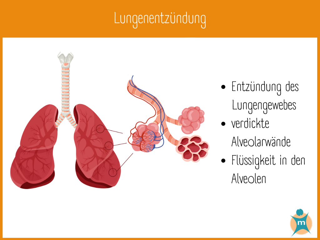 Lungenentzündung | Ihre Apotheke informiert