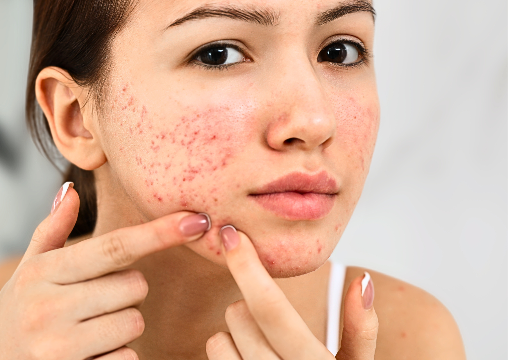 Was tun bei unreiner Haut? Pflegetipps von Ihrer Apotheke