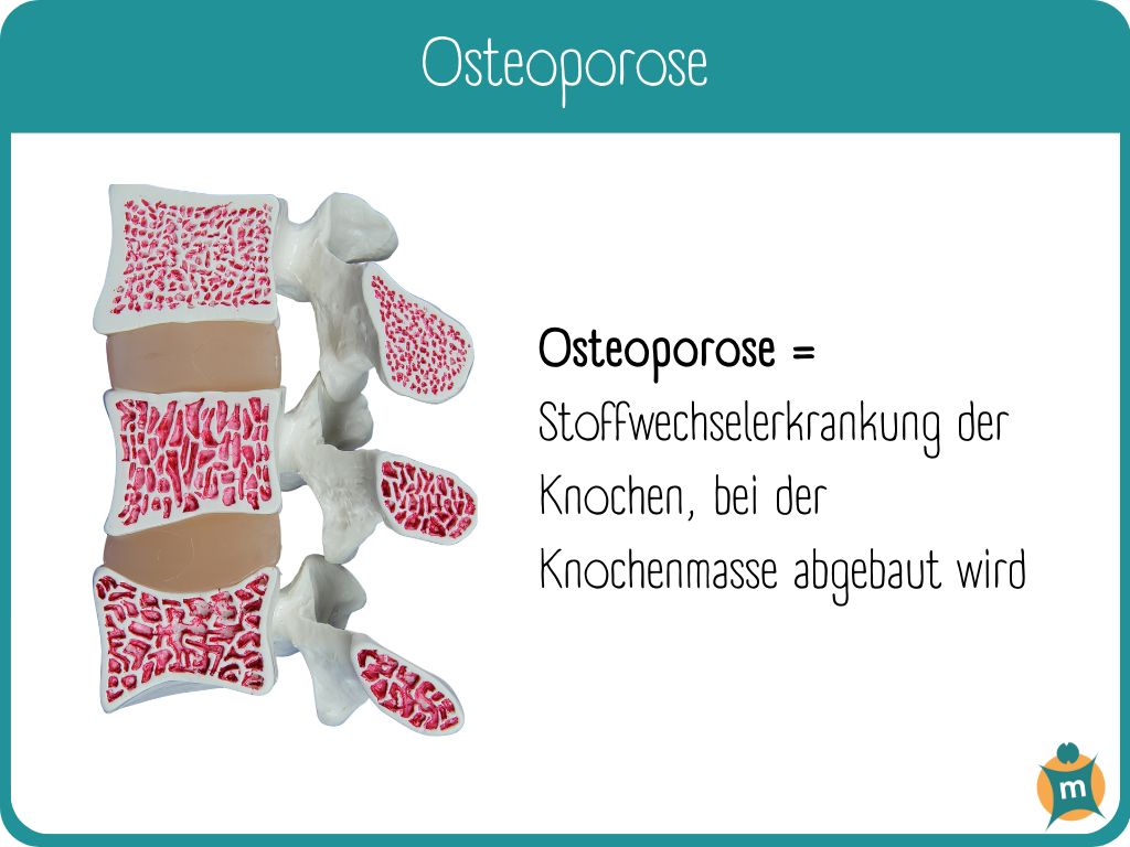 Osteoporose | Ihre Apotheke informiert über Krankheiten › Info-Seite -  medikamente-per-klick